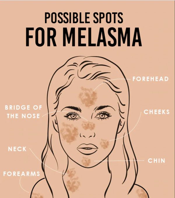 How to Treat Melasma at Home, According to Beauty Experts