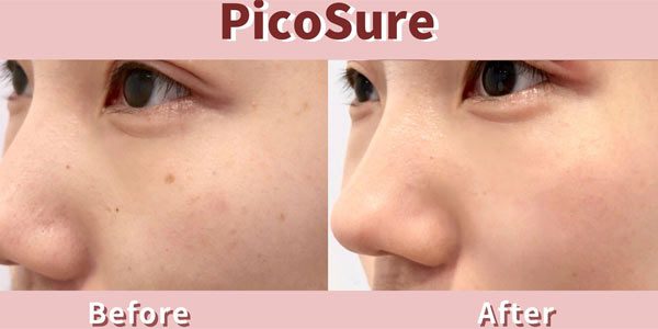 PicoSure Laser Treatment: Say Goodbye to Acne Scars and Enlarged Pores
