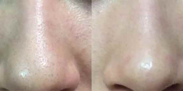 Accutane Blackheads Before and After