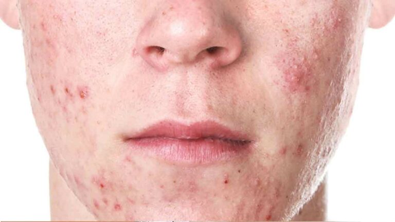 Combat Hormonal Acne in Men with These Effective Strategies