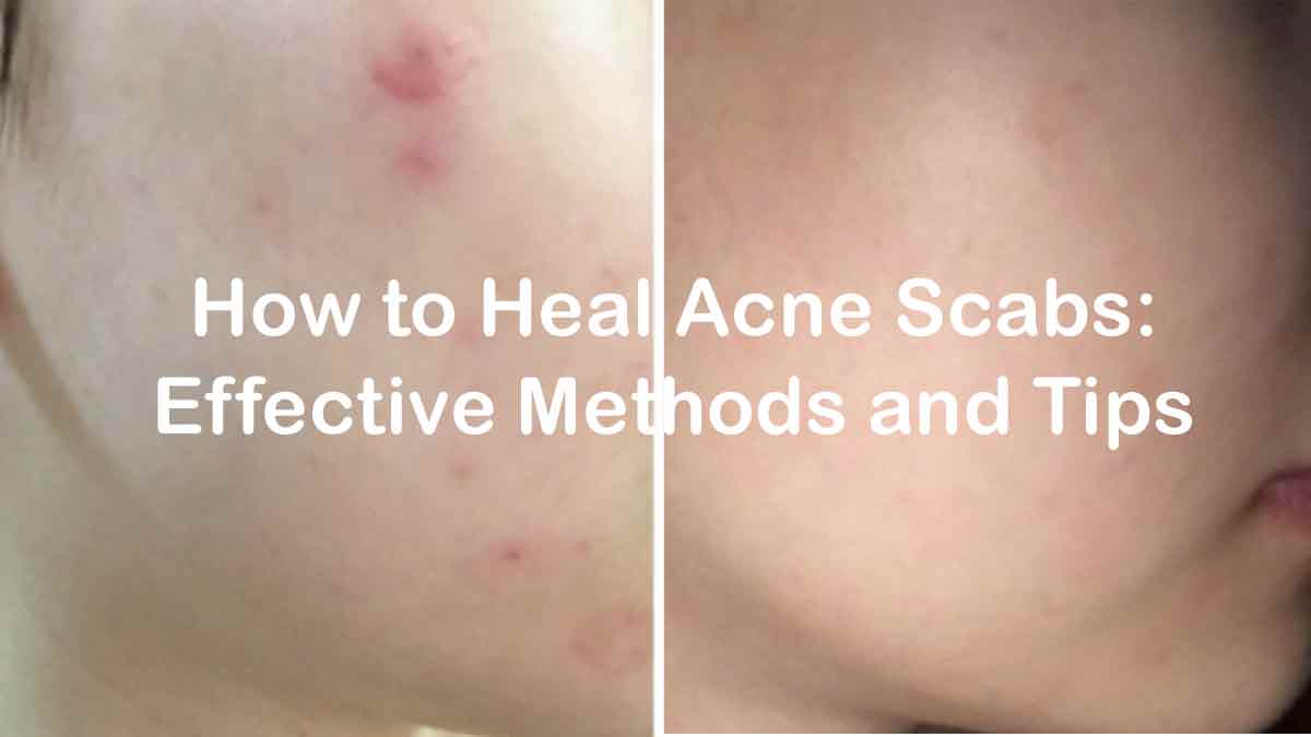 How to Heal Acne Scabs: Effective Methods and Tips
