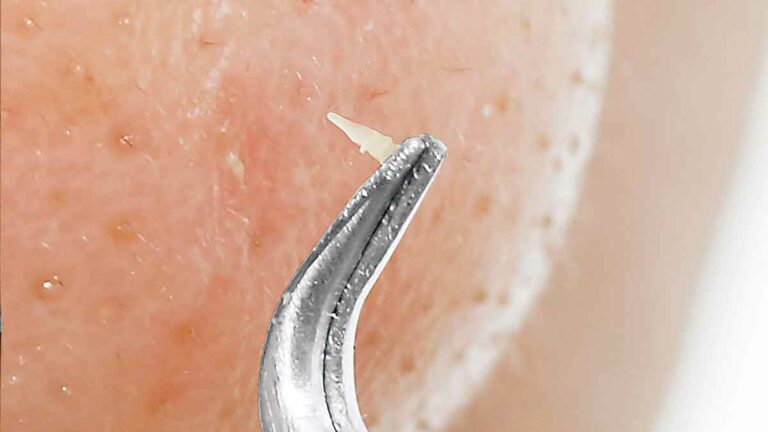 Removing Sebum Plugs: Essential Tools and Techniques Revealed