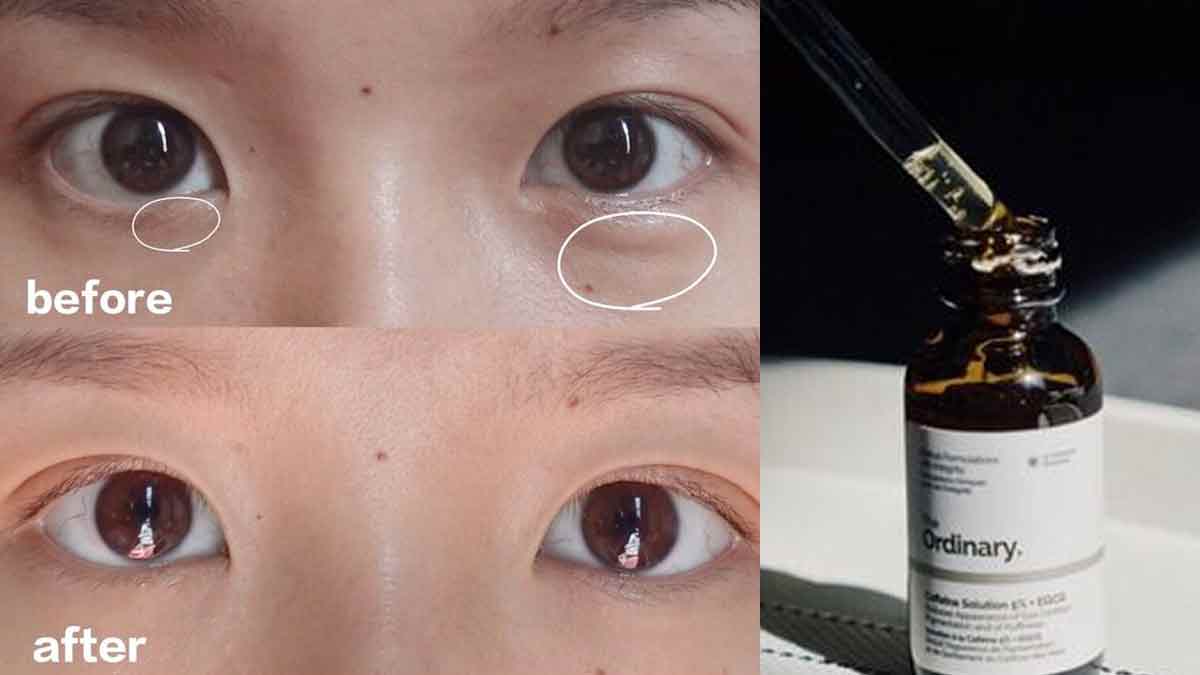 Say Goodbye to Dark Circles: The Ordinary Caffeine Solution Before and After