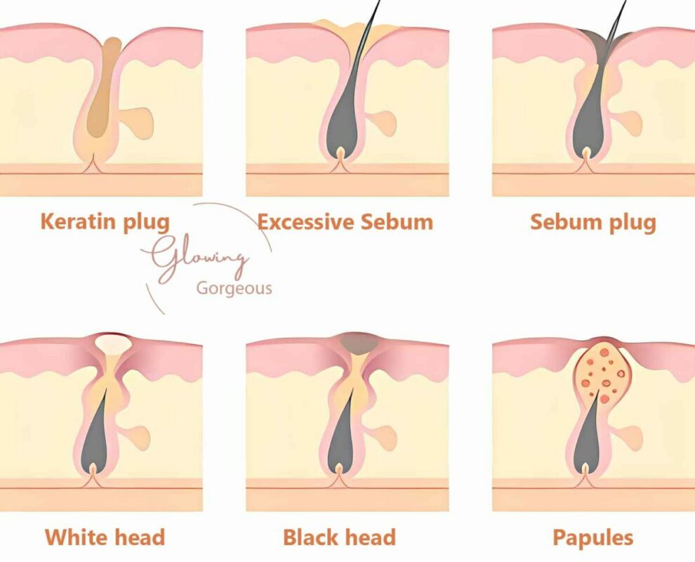 difference between keratin plug, sebum plug, white head, black head, papules