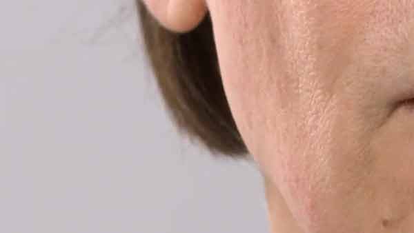 My Sonicsmooth Dermaplaning After